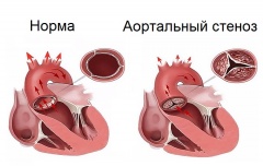 Что такое аортальный стеноз